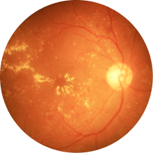 希瑪林順潮眼科中心_黃斑病變