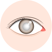 希瑪林順潮眼科中心_青光眼