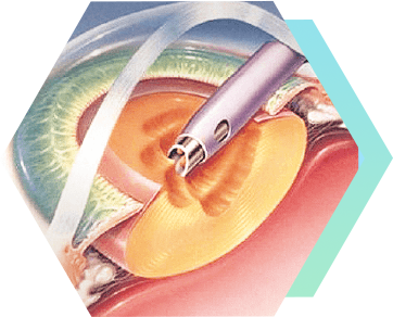 希瑪眼科中心_白內障手術_切除晶體混濁