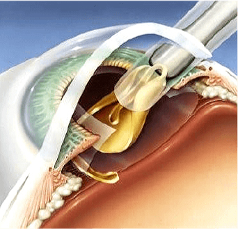 CMER Eye Center_ treatment of cataract_ intraocular lens (IOL) implantation