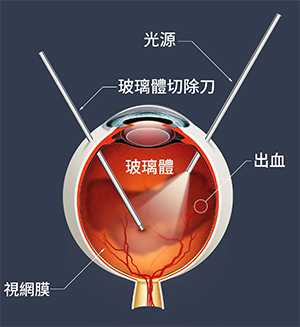 希瑪眼科中心_飛蚊症治療_玻璃體切除治療