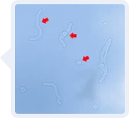 希瑪眼科中心_飛蚊症種類_良性飛蚊