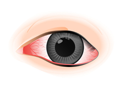 希瑪眼科中心_結膜炎症狀_結膜充血