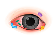 希瑪眼科中心_細菌性結膜炎