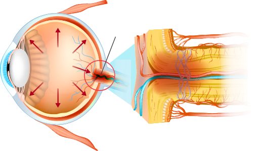 希瑪眼科中心_青光眼