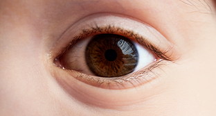 希瑪眼科中心_先天性青光眼_角膜擴大