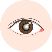 希瑪眼科中心_白內障