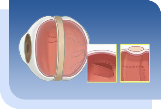 希瑪眼科中心_視網膜脫落治療_鞏膜外墊壓術 希瑪眼科中心_視網膜脫落治療_鞏膜外墊壓術