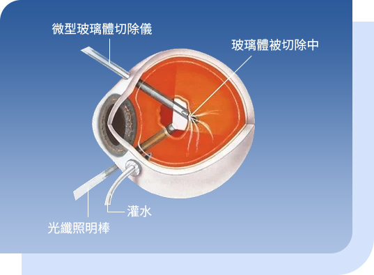 希瑪眼科中心_視網膜脫落治療_微創玻璃體切除術 希瑪眼科中心_視網膜脫落治療_微創玻璃體切除術